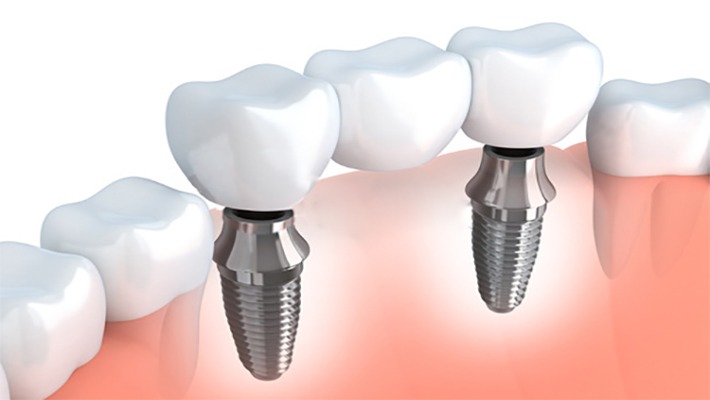 implantes dentales en Madrid