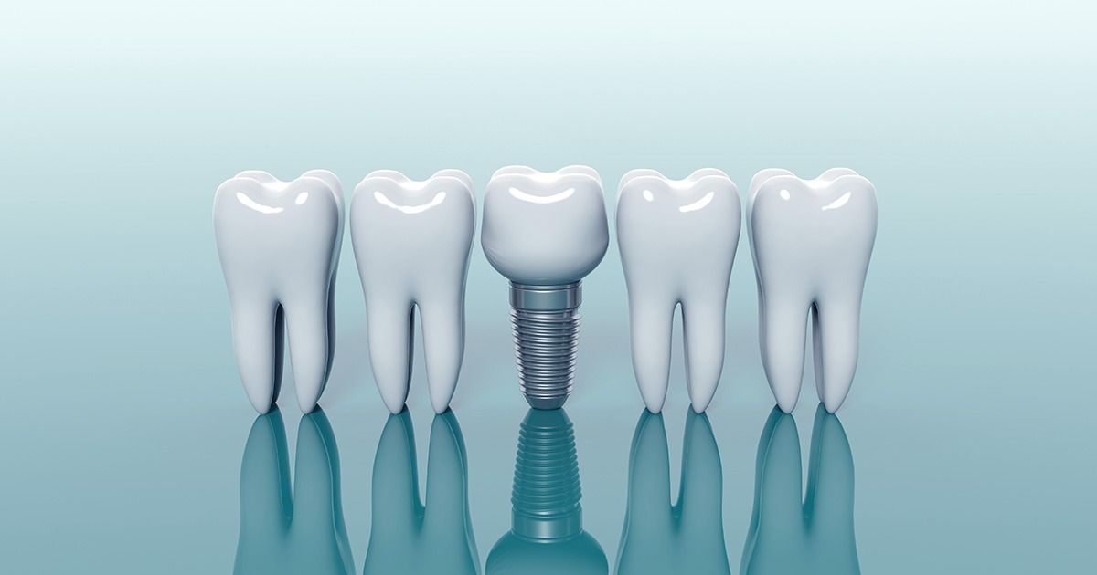 ¿Sabes para qué se usan los implantes dentales? - Clínica dental Madrid | Dental Corbella
