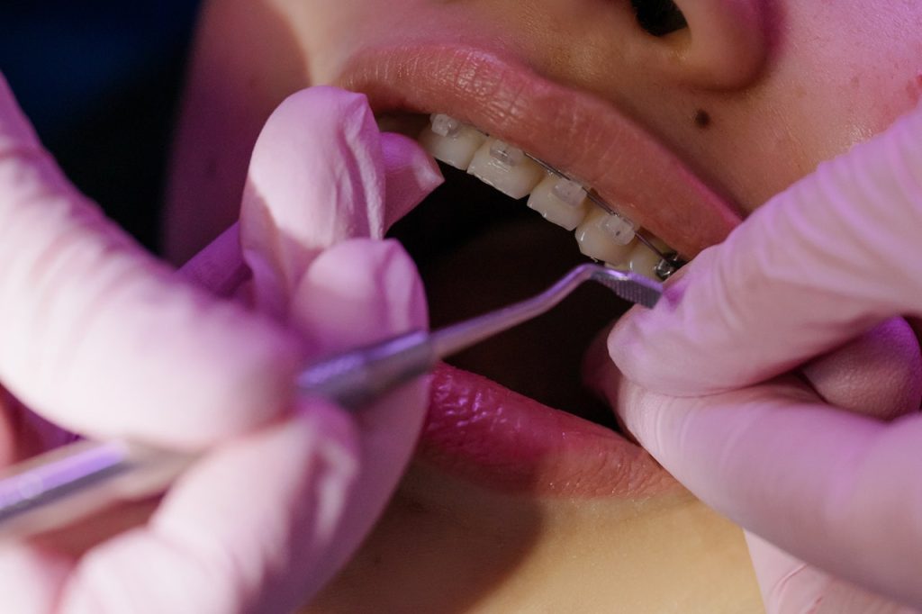 Alineadores dentales: en busca de la sonrisa perfecta - Clínica dental Madrid | Dental Corbella