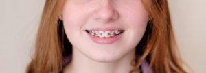 Apiñamiento dental: ¿cómo corregirlo? - Clínica dental Madrid | Dental Corbella